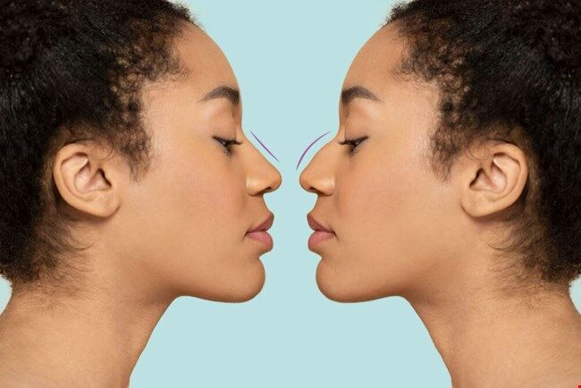 Ethnic Rhinoplasty: How Hip-Hop Celebrities Reshaped the Conversation Around Nose Jobs
